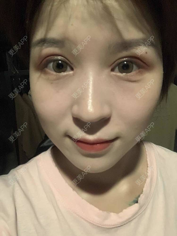 更美 - 徐金玉 医生的全切双眼皮经验 | 开眼角 | 全切双眼皮