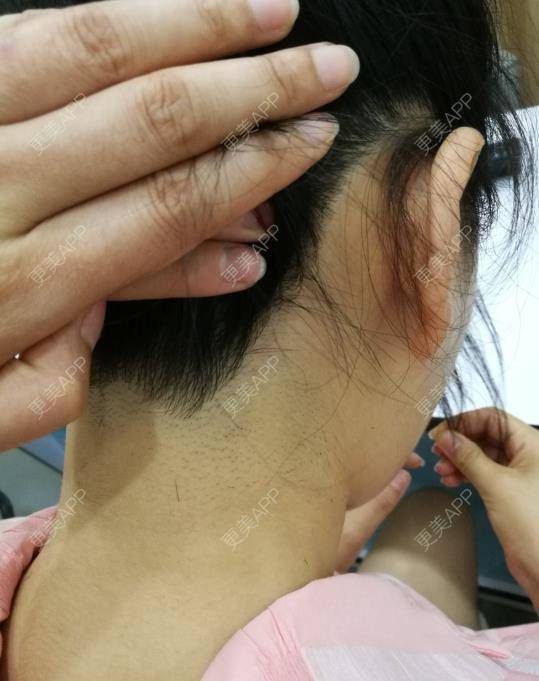 更美用户uozirxcilv的激光脱发际线日记