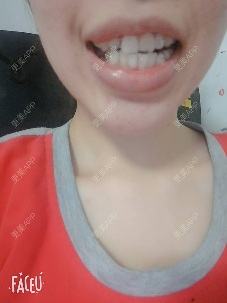 更美 - 西瓜西瓜圓又大🍉的隐形牙齿矫正经验 | 隐形牙齿矫正 | 上海