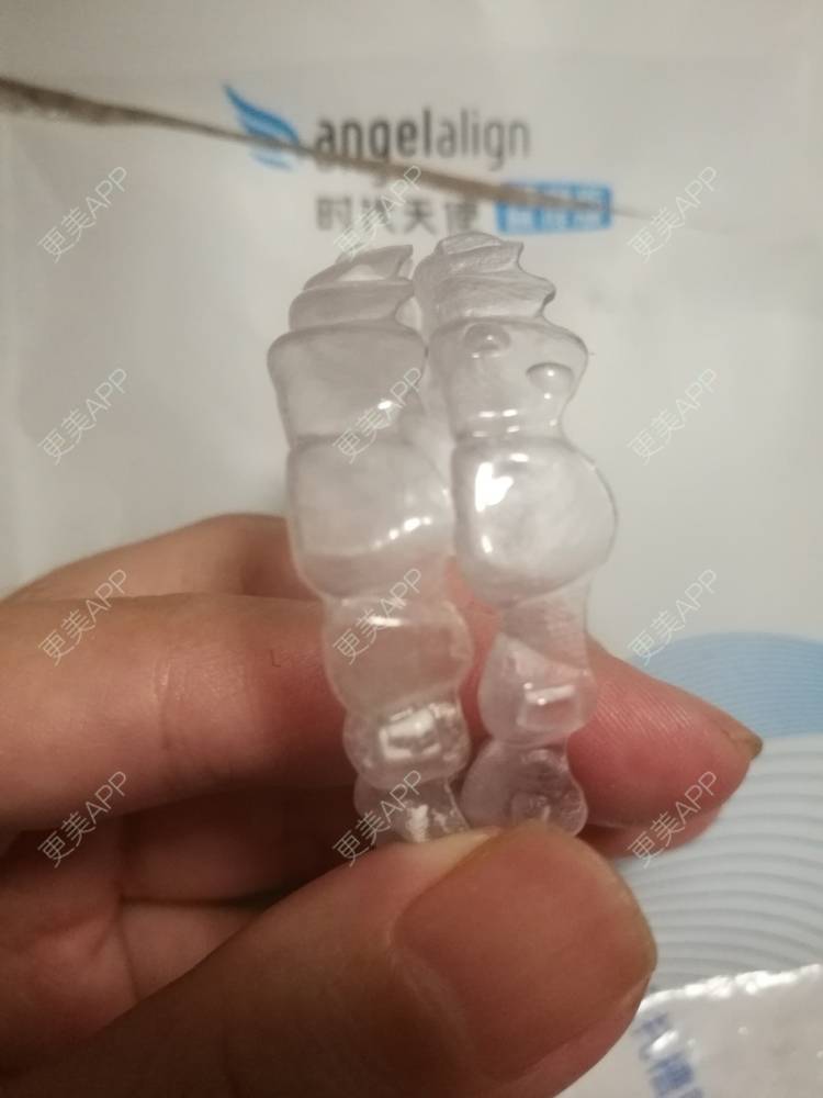 更美 - 西瓜西瓜圓又大🍉的隐形牙齿矫正经验 | 隐形牙齿矫正 | 上海