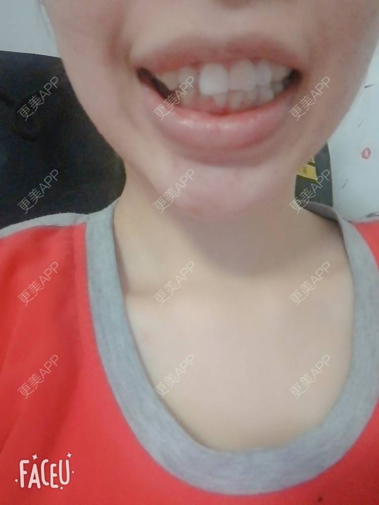 更美 - 西瓜西瓜圓又大🍉的隐形牙齿矫正经验 | 隐形牙齿矫正 | 上海