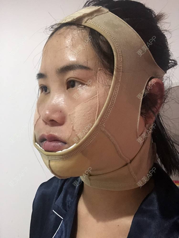 我需要你给的美丶的下颌角切除术日记