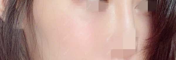 更美 - 更美用户5rDBoH8mJq的自体脂肪丰苹果肌经验 | 自体脂肪丰苹果肌 | 北京