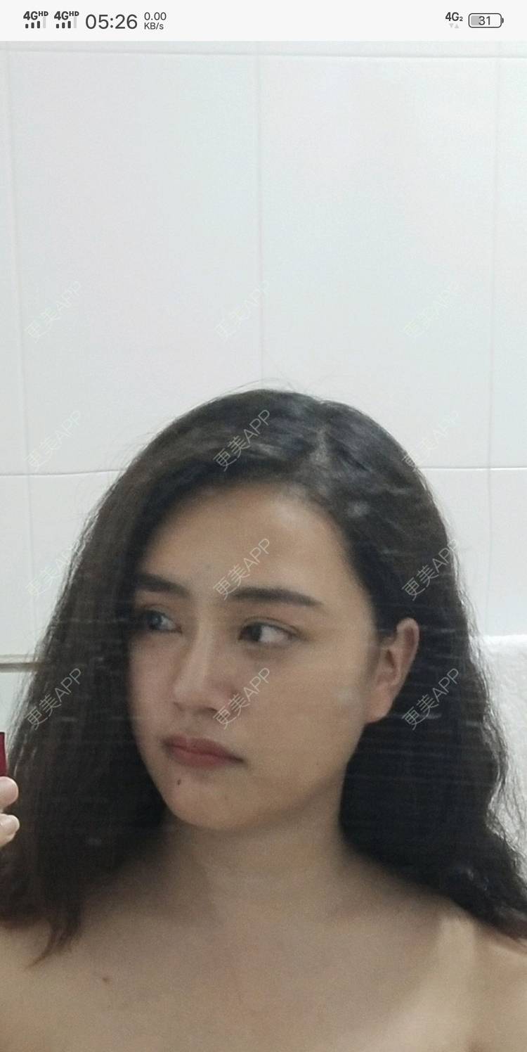 更美 - 红薯冰的硅胶垫眉弓经验 | 北京 | 硅胶垫眉弓