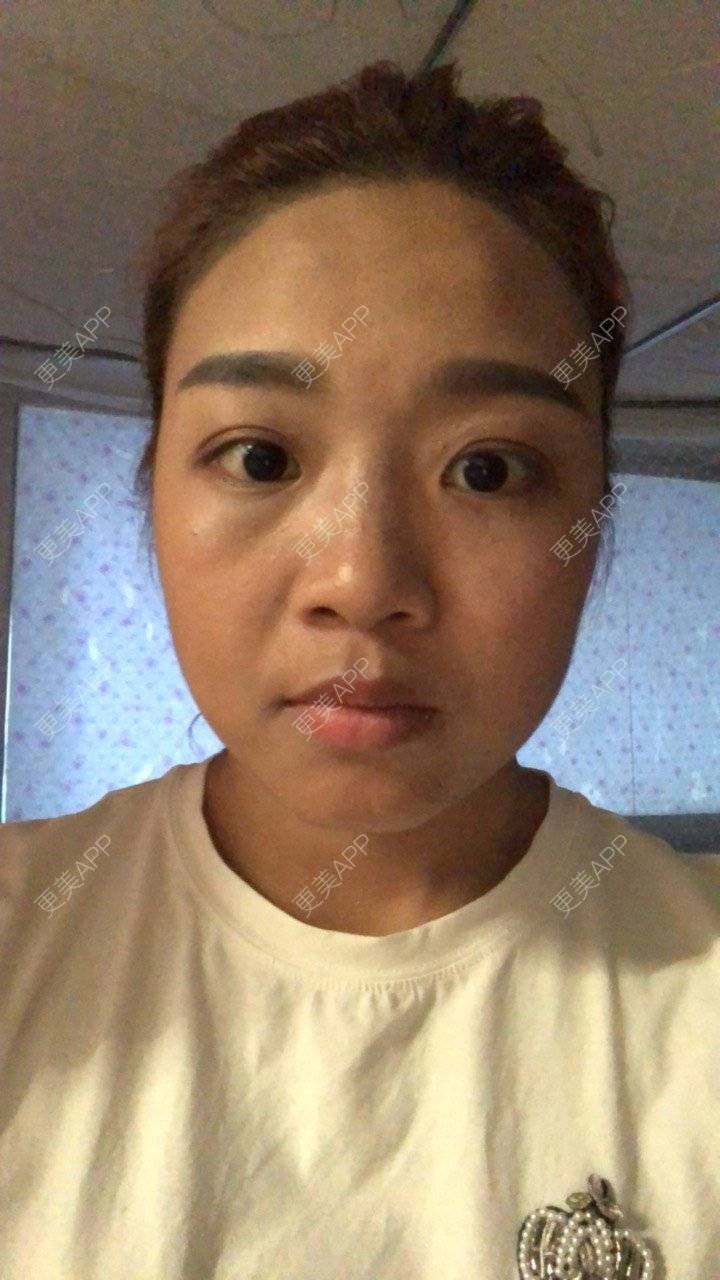 更美 - 更美用户6RS5Xe8h5s的半永久纹发际线经验 | 广州 | 半永久纹发际线
