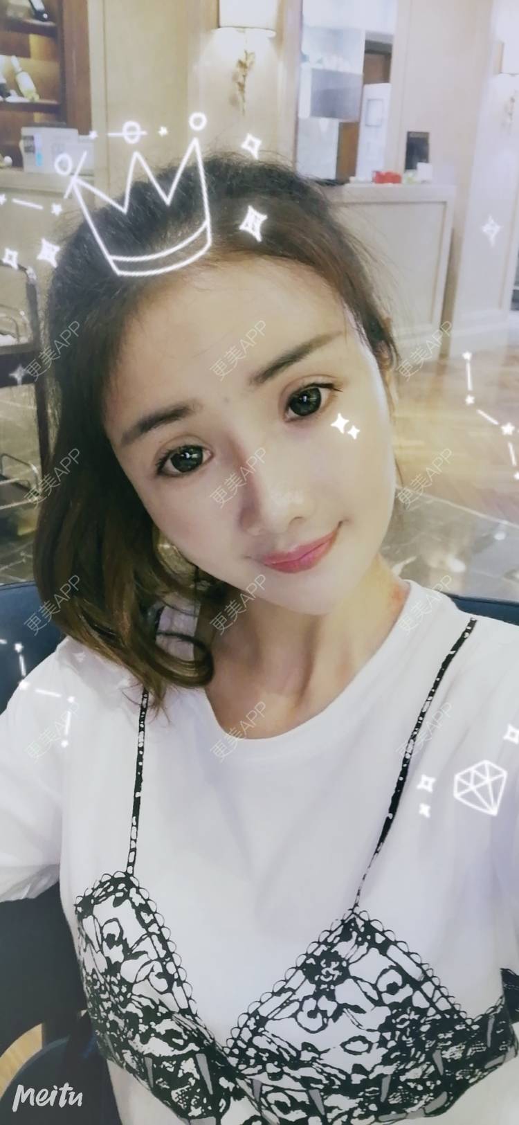 更美 - 酢乙女爱+花轮的玻尿酸经验 | 南京 | 玻尿酸 | 玻尿酸套餐