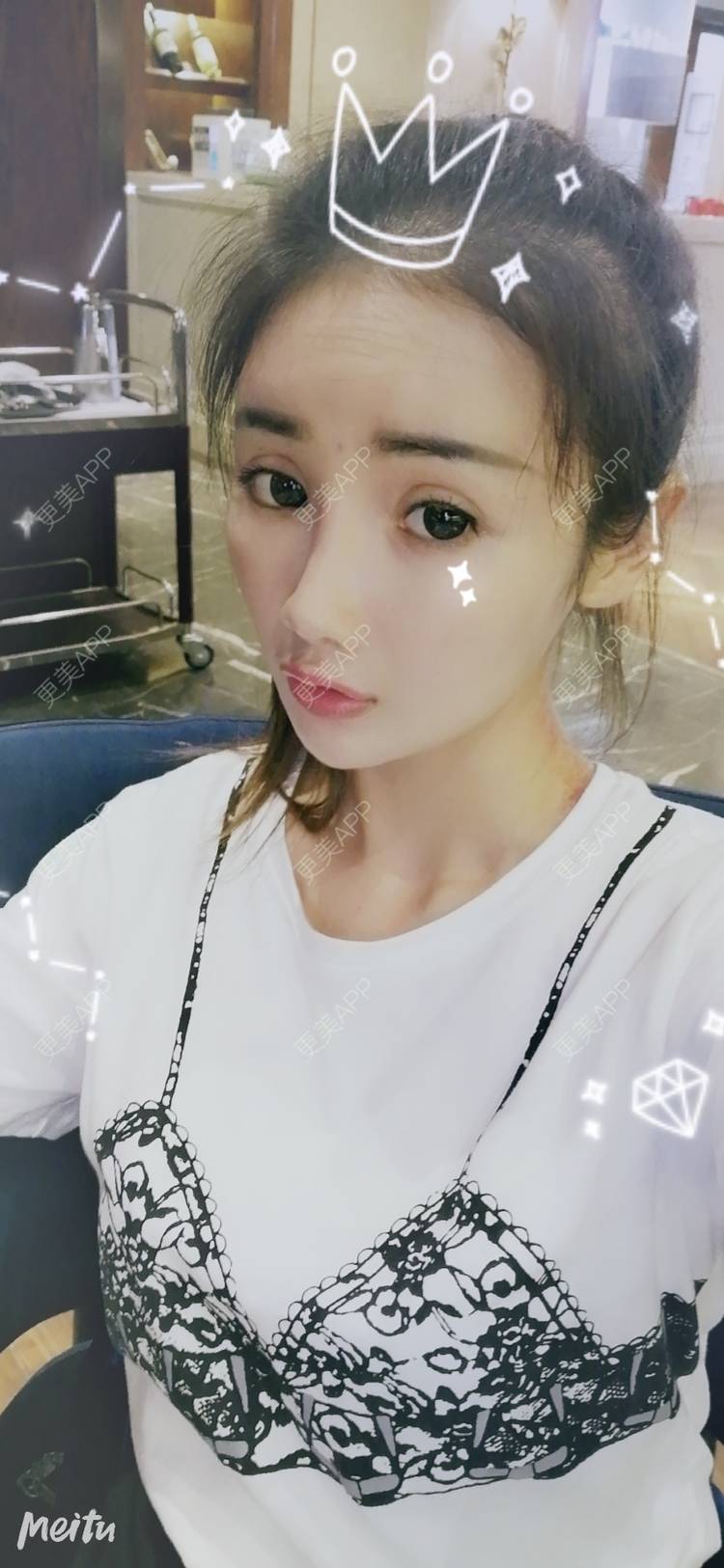 更美 - 酢乙女爱+花轮的玻尿酸经验 | 南京 | 玻尿酸 | 玻尿酸套餐