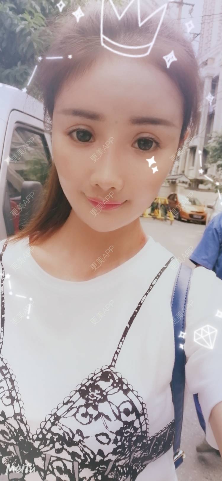 更美 - 酢乙女爱+花轮的玻尿酸经验 | 南京 | 玻尿酸 | 玻尿酸套餐