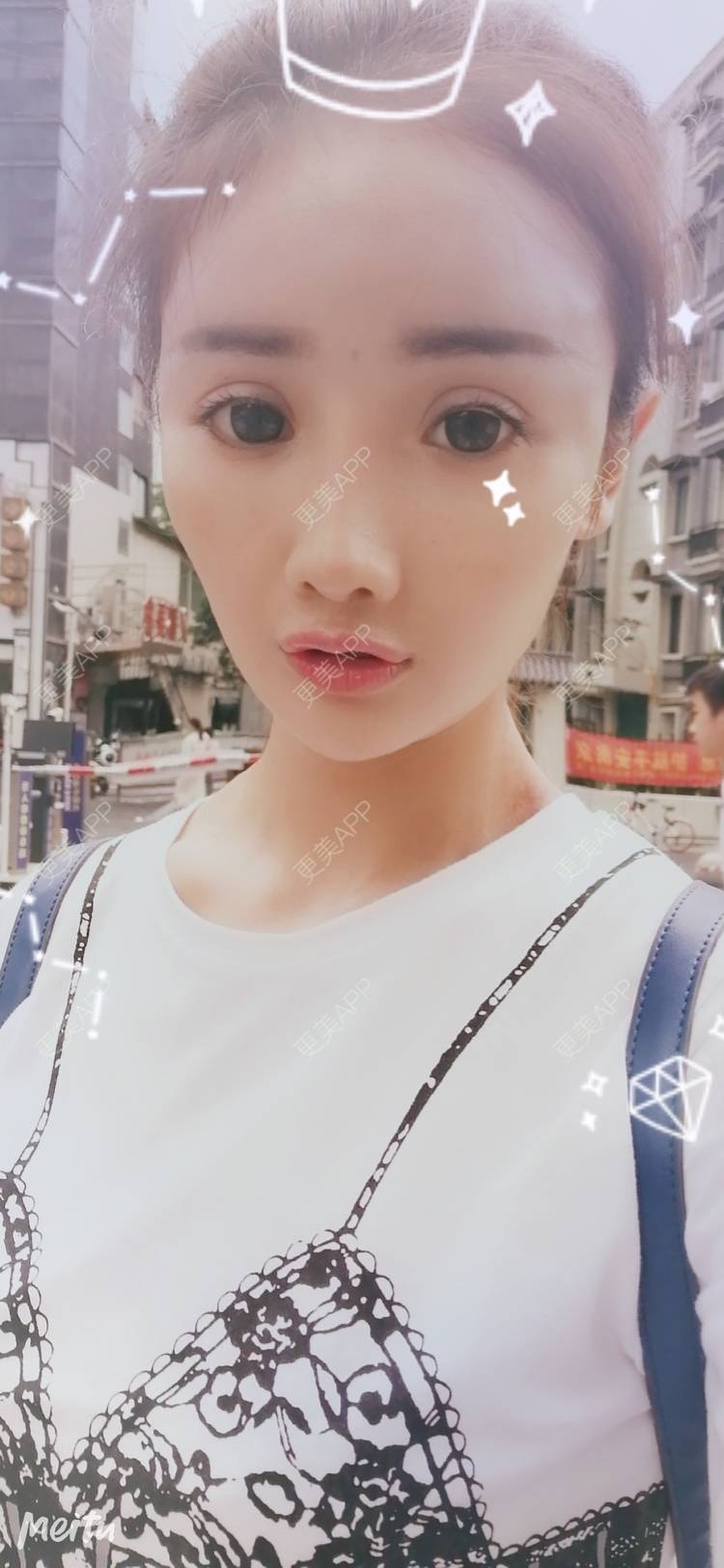 更美 - 酢乙女爱+花轮的玻尿酸经验 | 南京 | 玻尿酸 | 玻尿酸套餐