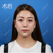 更美 - 上饶尚美医疗美容门诊部的隆鼻经验 | 隆鼻