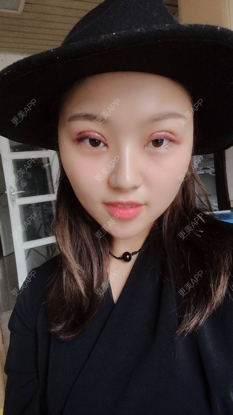 更美 - 孤颜微沁的全切双眼皮经验 | 全切双眼皮 | 开内眼角 | 开眼角修复 | 眼部多项 | 双眼皮修复 | 重庆 | 定点双眼皮