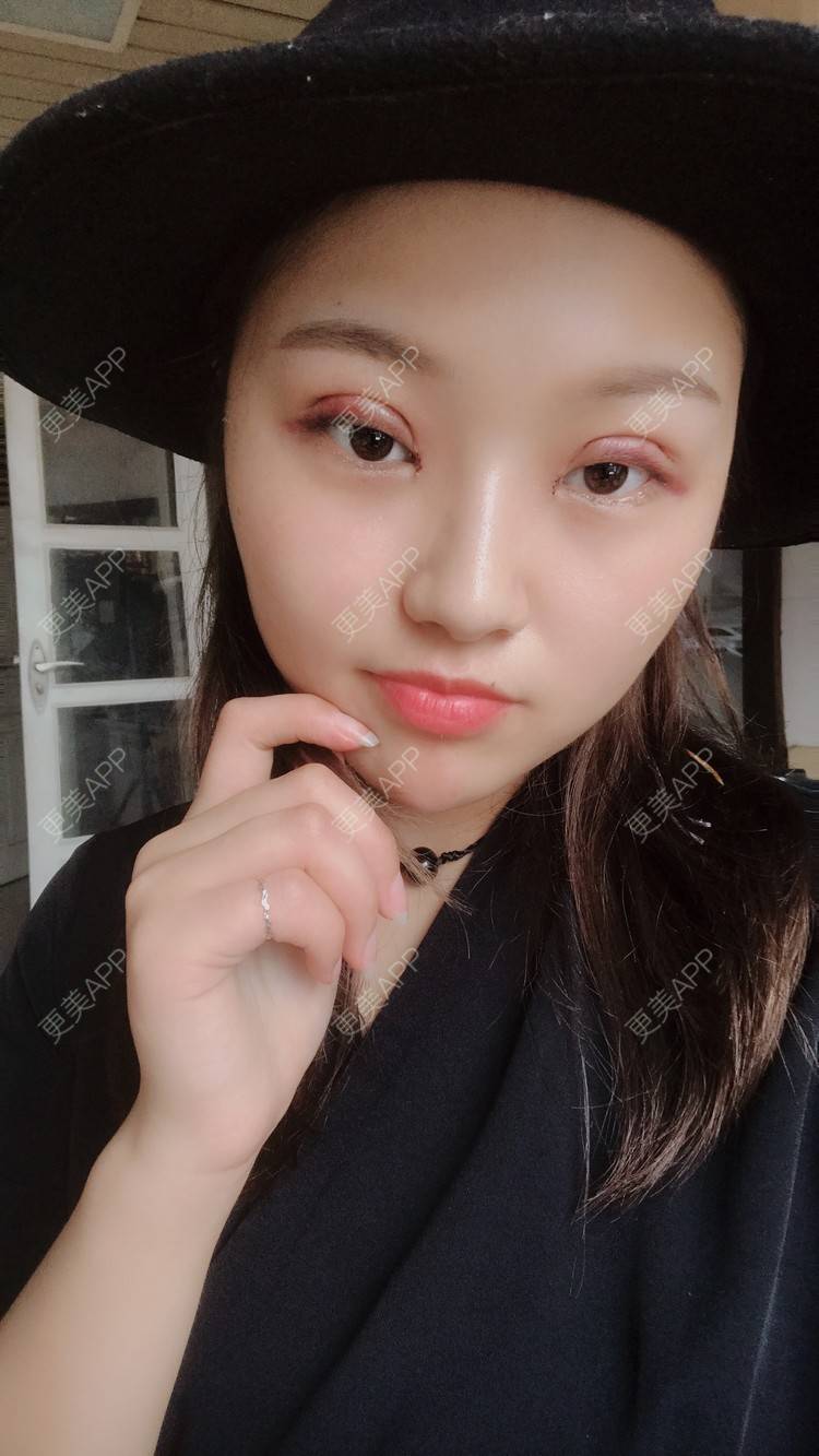 更美 - 孤颜微沁的全切双眼皮经验 | 全切双眼皮 | 开内眼角 | 开眼角修复 | 眼部多项 | 双眼皮修复 | 重庆 | 定点双眼皮