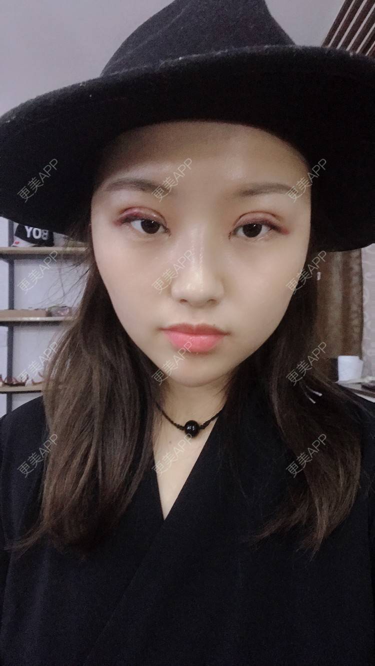更美 - 孤颜微沁的全切双眼皮经验 | 全切双眼皮 | 开内眼角 | 开眼角修复 | 眼部多项 | 双眼皮修复 | 重庆 | 定点双眼皮