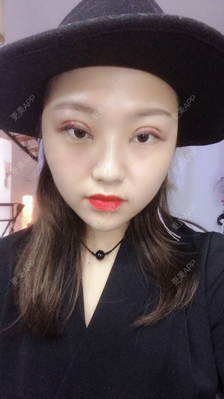 更美 - 孤颜微沁的全切双眼皮经验 | 全切双眼皮 | 开内眼角 | 开眼角修复 | 眼部多项 | 双眼皮修复 | 重庆 | 定点双眼皮