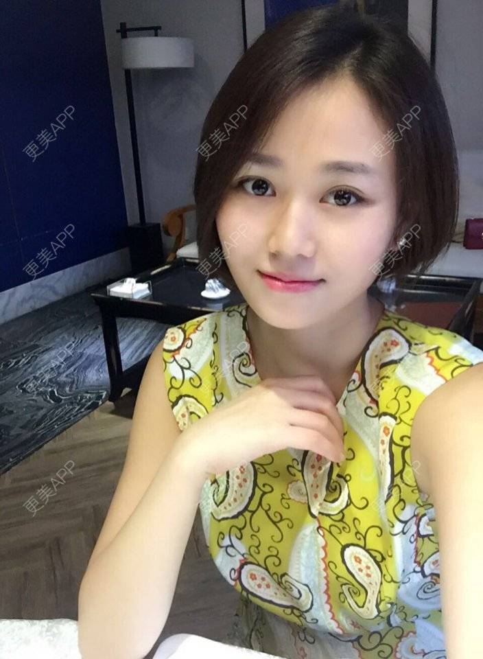 更美 - 顽固不化的假体垫苹果肌经验 | 北京 | 假体垫苹果肌