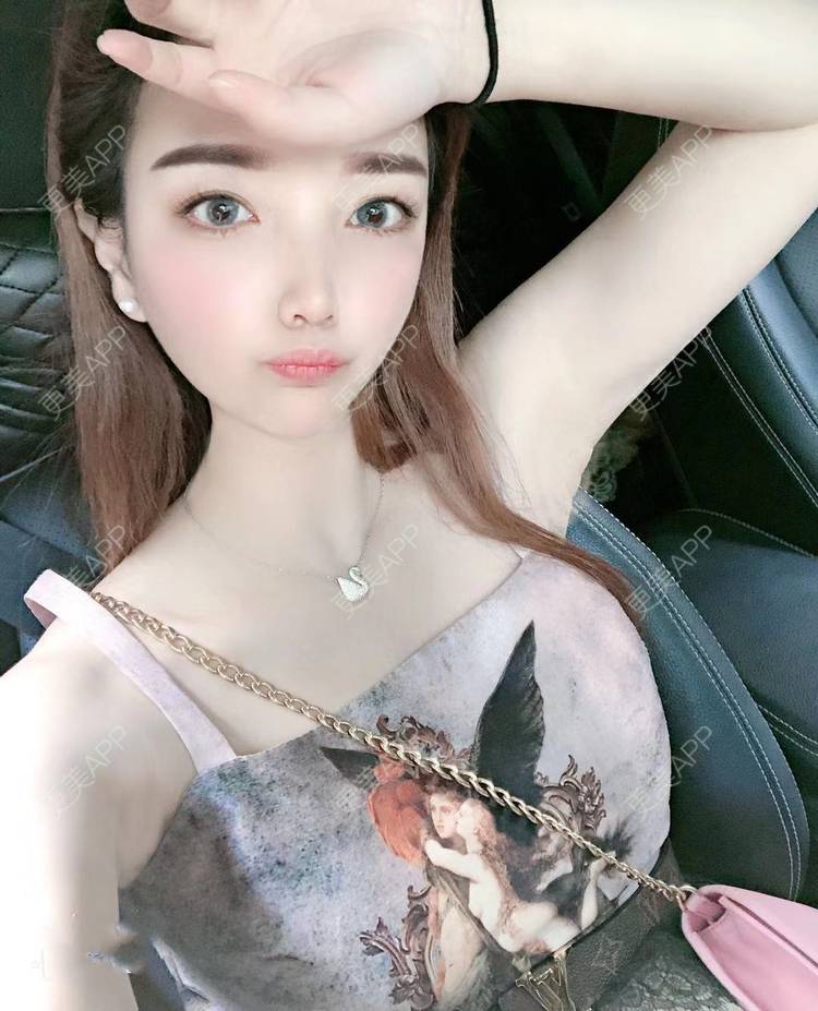 更美 - 更美用户EWqDuvHmIb的自体脂肪丰面颊经验 | 自体脂肪丰面颊 | 成都