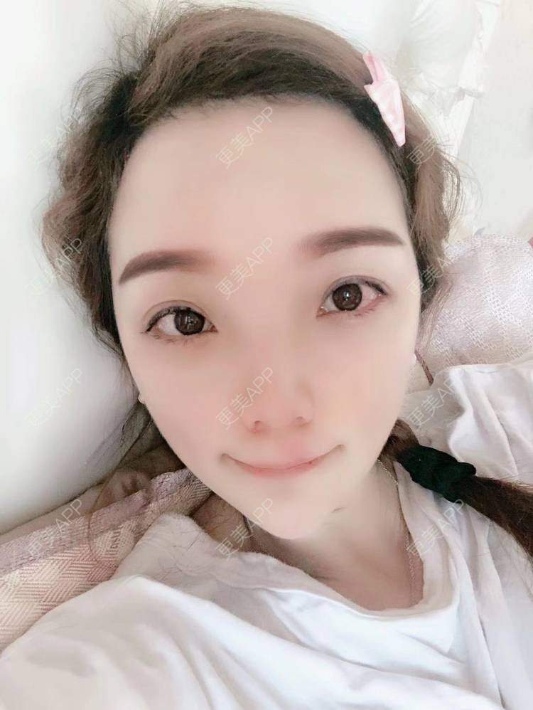 更美 - 更美用户EWqDuvHmIb的自体脂肪丰面颊经验 | 自体脂肪丰面颊 | 成都