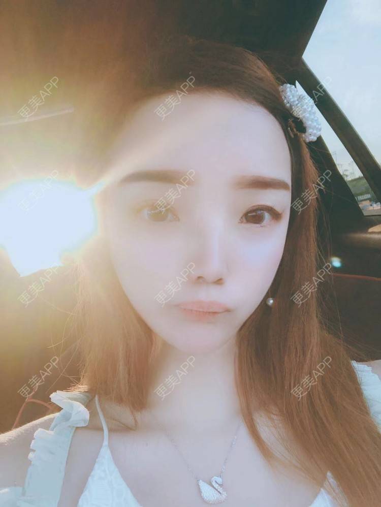 更美 - 更美用户EWqDuvHmIb的自体脂肪丰面颊经验 | 自体脂肪丰面颊 | 成都