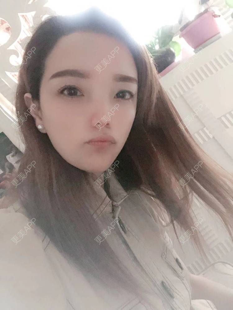 更美 - 更美用户EWqDuvHmIb的自体脂肪丰面颊经验 | 自体脂肪丰面颊 | 成都