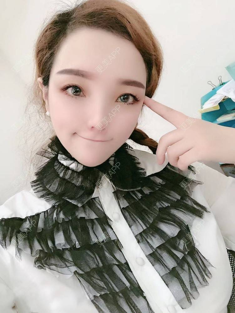 更美 - 更美用户EWqDuvHmIb的自体脂肪丰面颊经验 | 自体脂肪丰面颊 | 成都