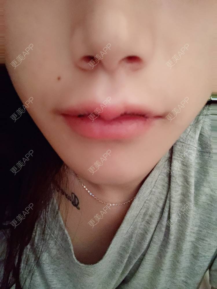 更美用户wtexaqeddy的m唇成形日记