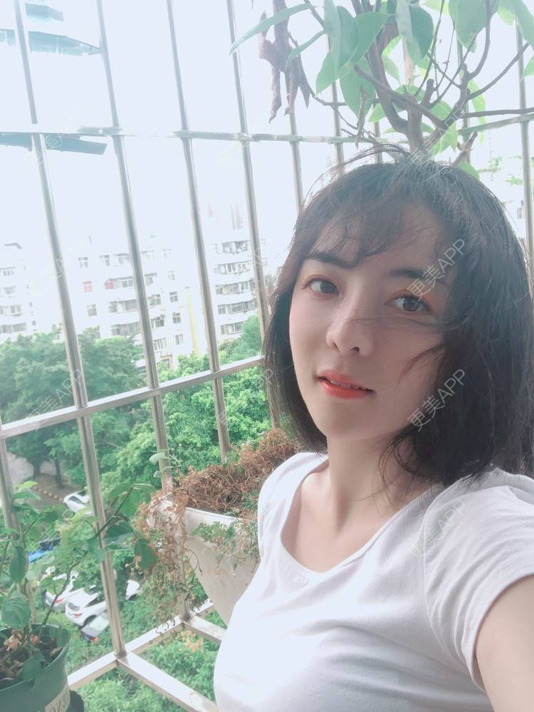 更美 - 向阳葵21的植发际线经验 | 植眉 | 植发际线 | 广州