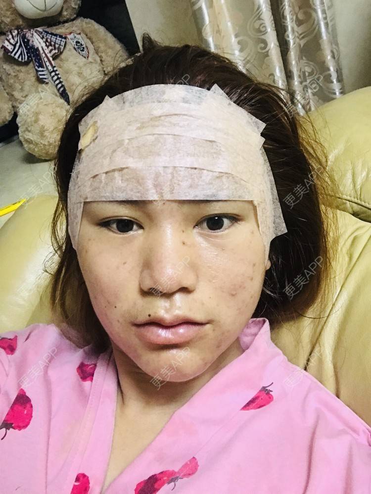 更美 - 晓颖baby的自体脂肪丰太阳穴经验 | 玻尿酸唇部 | 自体脂肪丰额头 | 自体脂肪丰太阳穴 | 自体脂肪垫眉弓 | 成都