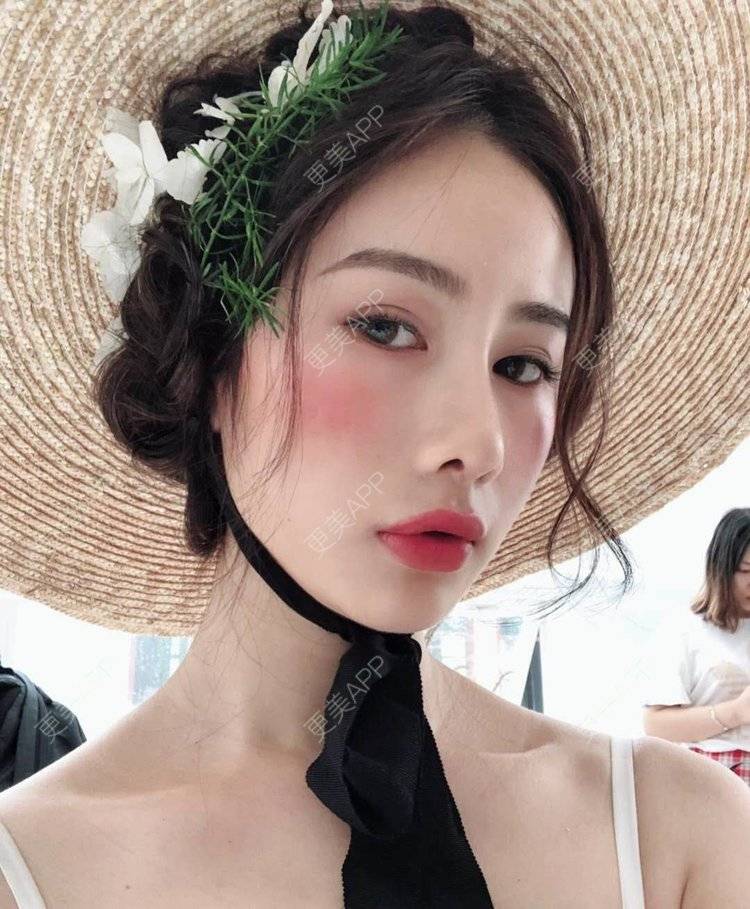 更美 - 李现的现女友的歪鼻矫正经验 | 重庆 | 肋软骨隆鼻 | 鼻孔矫正 | 歪鼻矫正 | 鼻翼缩小
