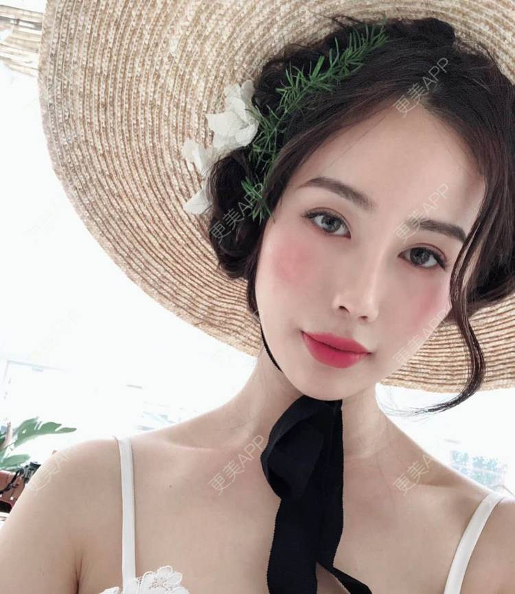 更美 - 李现的现女友的歪鼻矫正经验 | 重庆 | 肋软骨隆鼻 | 鼻孔矫正 | 歪鼻矫正 | 鼻翼缩小