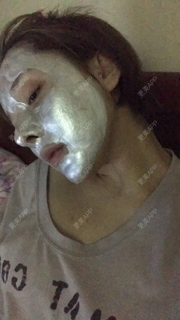 更美 - 更美用户X585v75GsV的鼻部多项经验 | 鹰钩鼻矫正 | 鼻形矫正 | 鼻部多项 | 南京