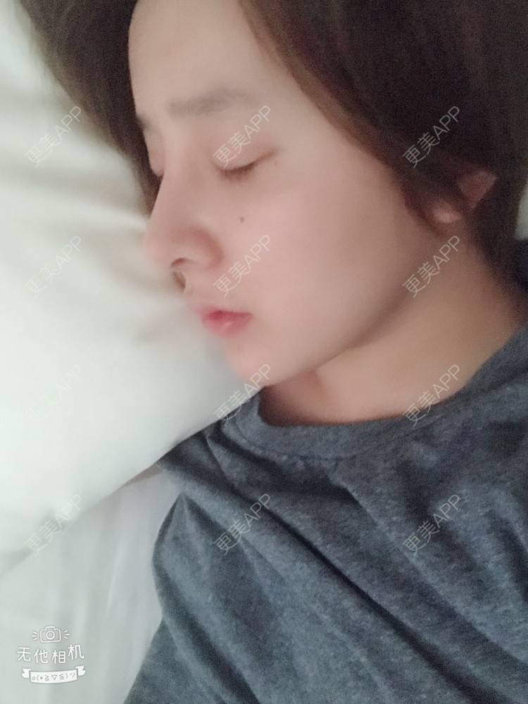 更美 - 更美用户X585v75GsV的鼻部多项经验 | 鹰钩鼻矫正 | 鼻形矫正 | 鼻部多项 | 南京