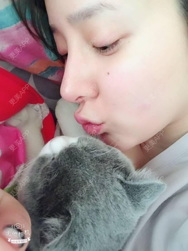 更美 - 更美用户X585v75GsV的鼻部多项经验 | 鹰钩鼻矫正 | 鼻形矫正 | 鼻部多项 | 南京