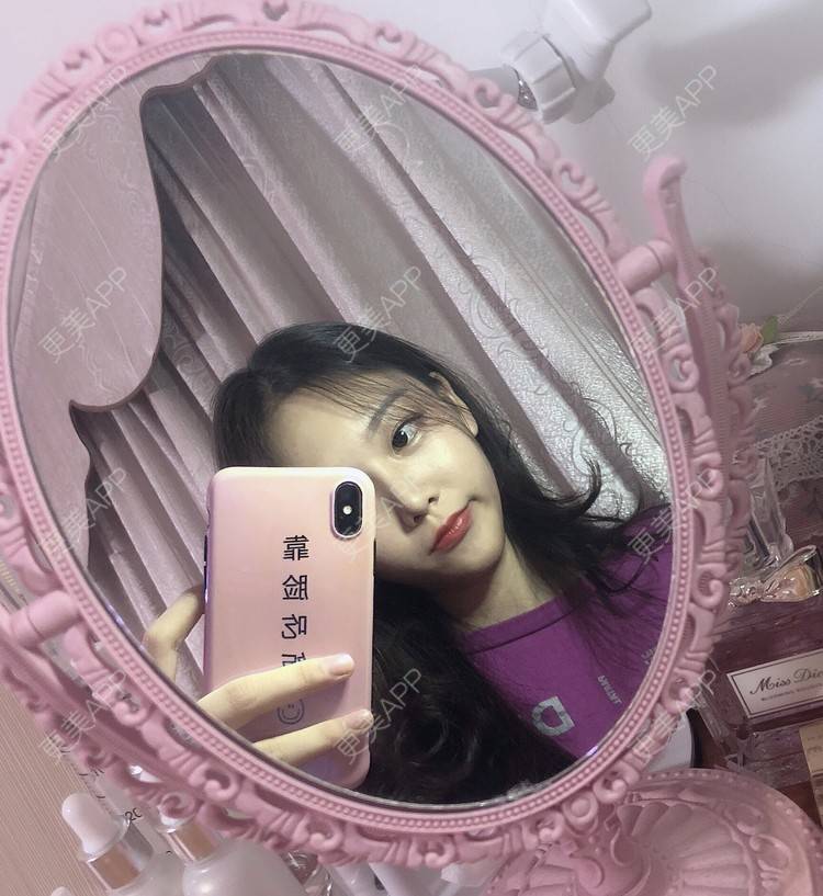 更美 - 本仙女不是妖🧚的鼻部多项经验 | 鼻部多项 | 鼻部综合 | 鼻部修复 | 鼻部膨体假体取出 | 手术缩鼻头 | 鼻翼缩小 | 广州 | 鼻中隔软骨垫鼻头 | 鼻孔矫正 | 鼻基底 | 鼻小柱缩短 | 自体肋软骨垫鼻基底