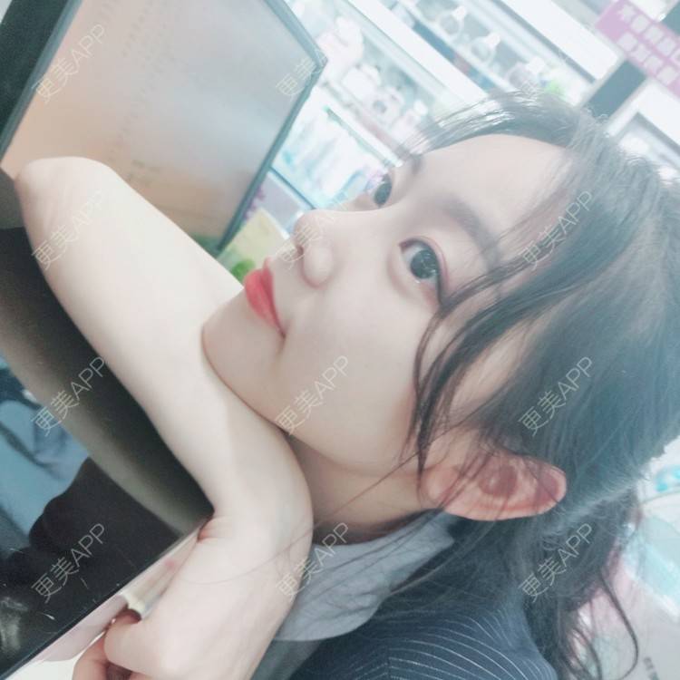 更美 - 本仙女不是妖🧚的鼻部多项经验 | 隆鼻 | 肋软骨隆鼻 | 驼峰鼻矫正 | 长鼻矫正 | 鼻部修复 | 鼻部多项 | 手术缩鼻头 | 鼻翼缩小 | 广州 | 鼻中隔软骨垫鼻头 | 鼻孔矫正 | 鼻基底 | 鼻小柱缩短 | 鼻部综合 | 自体肋软骨垫鼻基底