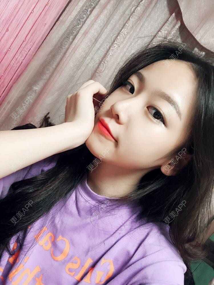 更美 - 本仙女不是妖🧚的鼻部多项经验 | 隆鼻 | 鼻部修复 | 鼻部膨体假体取出 | 鼻部综合 | 鼻部多项 | 手术缩鼻头 | 鼻翼缩小 | 广州 | 鼻中隔软骨垫鼻头 | 鼻孔矫正 | 鼻基底 | 鼻小柱缩短 | 自体肋软骨垫鼻基底