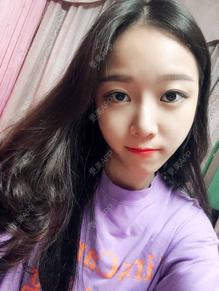 更美 - 本仙女不是妖🧚的鼻部多项经验 | 隆鼻 | 鼻部修复 | 鼻部膨体假体取出 | 鼻部综合 | 鼻部多项 | 手术缩鼻头 | 鼻翼缩小 | 广州 | 鼻中隔软骨垫鼻头 | 鼻孔矫正 | 鼻基底 | 鼻小柱缩短 | 自体肋软骨垫鼻基底