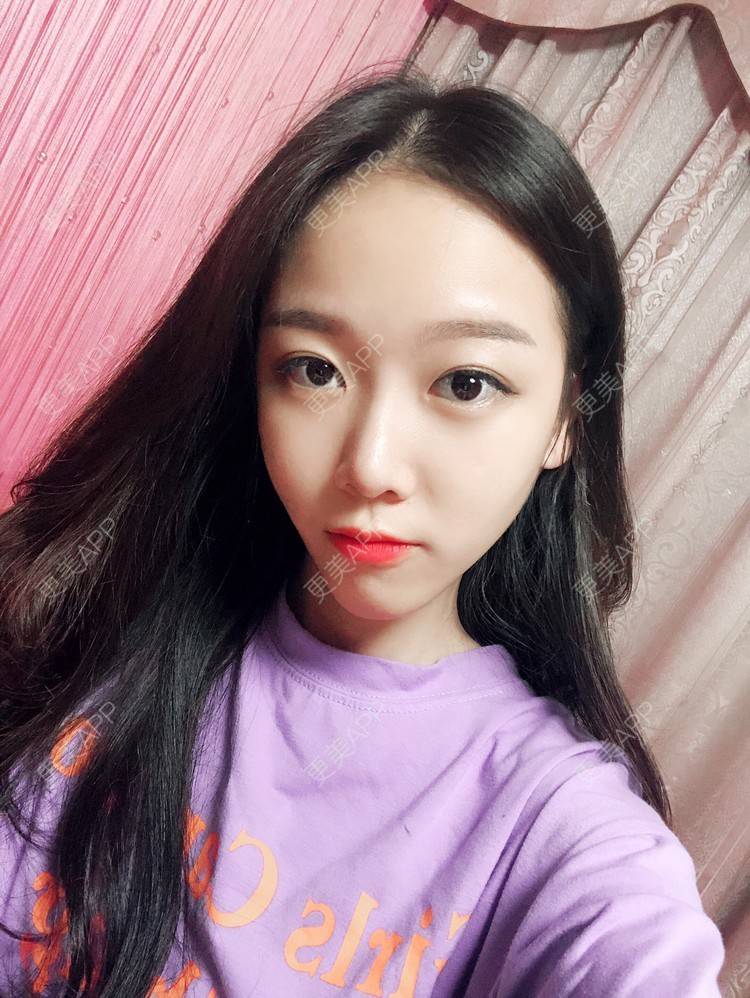 更美 - 本仙女不是妖🧚的鼻部多项经验 | 隆鼻 | 鼻部修复 | 鼻部膨体假体取出 | 鼻部综合 | 鼻部多项 | 手术缩鼻头 | 鼻翼缩小 | 广州 | 鼻中隔软骨垫鼻头 | 鼻孔矫正 | 鼻基底 | 鼻小柱缩短 | 自体肋软骨垫鼻基底