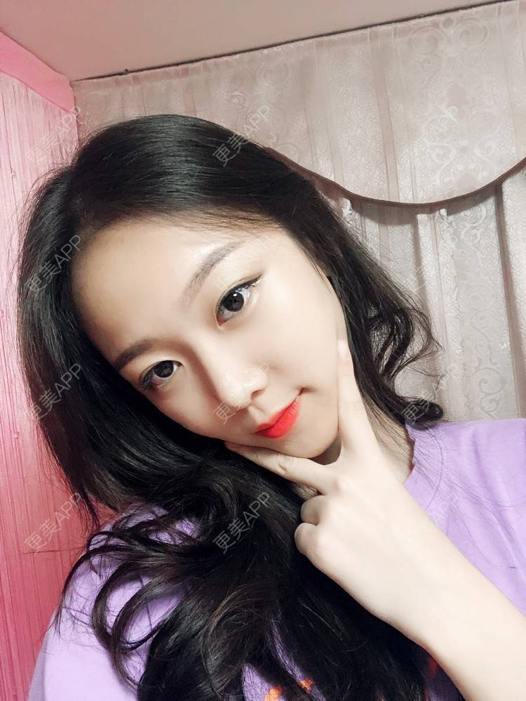 更美 - 本仙女不是妖🧚的鼻部多项经验 | 隆鼻 | 鼻部修复 | 鼻部膨体假体取出 | 鼻部综合 | 鼻部多项 | 手术缩鼻头 | 鼻翼缩小 | 广州 | 鼻中隔软骨垫鼻头 | 鼻孔矫正 | 鼻基底 | 鼻小柱缩短 | 自体肋软骨垫鼻基底