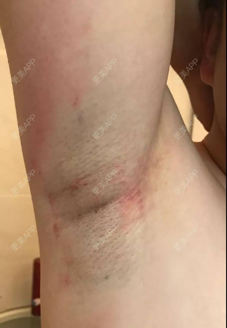 更美 - 更美用户ULKw7e3U38的激光除腋臭经验 | 成都 | 激光除腋臭