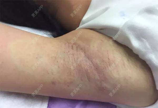 更美 - 更美用户ULKw7e3U38的激光除腋臭经验 | 成都 | 激光除腋臭