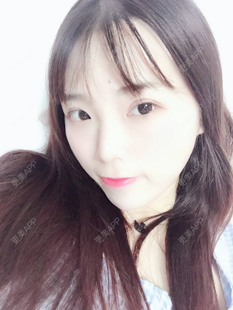 更美 - 叫我乖宝宝的鼻部多项经验 | 视频日记 | 鼻部多项 | 耳软骨隆鼻 | 硅胶隆鼻 | 南京 | 鼻部多项 | 南京