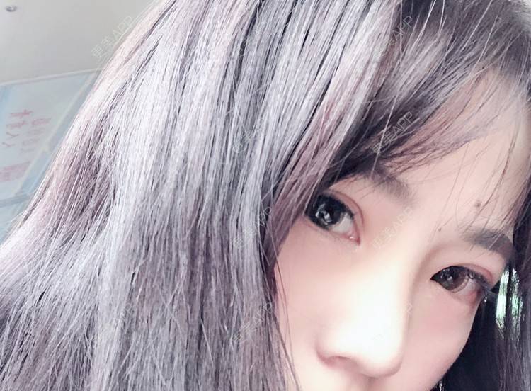 更美 - 叫我乖宝宝的鼻部多项经验 | 视频日记 | 鼻部多项 | 耳软骨隆鼻 | 硅胶隆鼻 | 南京 | 鼻部多项 | 南京