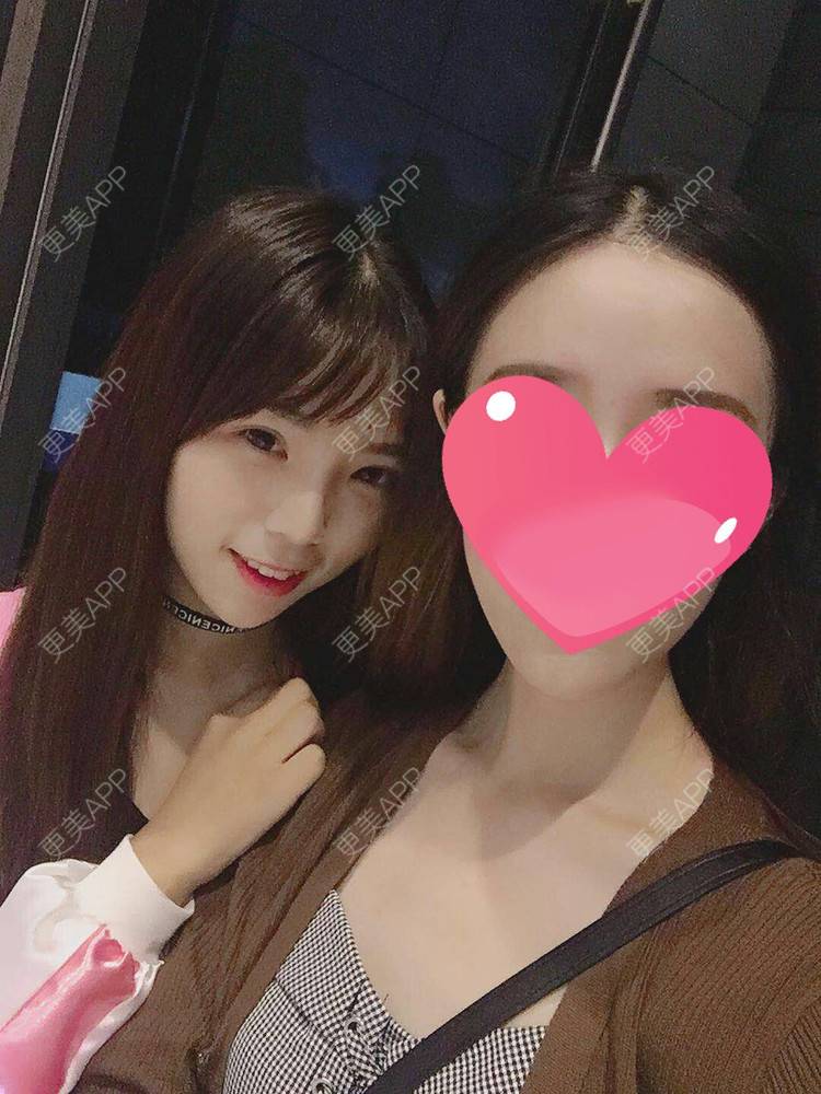 更美 - 叫我乖宝宝的鼻部多项经验 | 视频日记 | 鼻部多项 | 耳软骨隆鼻 | 硅胶隆鼻 | 南京 | 鼻部多项 | 南京