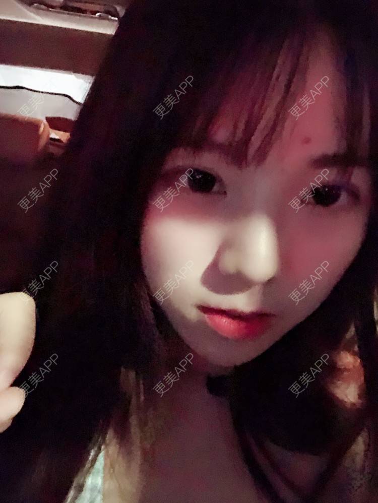 更美 - 叫我乖宝宝的鼻部多项经验 | 视频日记 | 鼻部多项 | 耳软骨隆鼻 | 硅胶隆鼻 | 南京 | 鼻部多项 | 南京