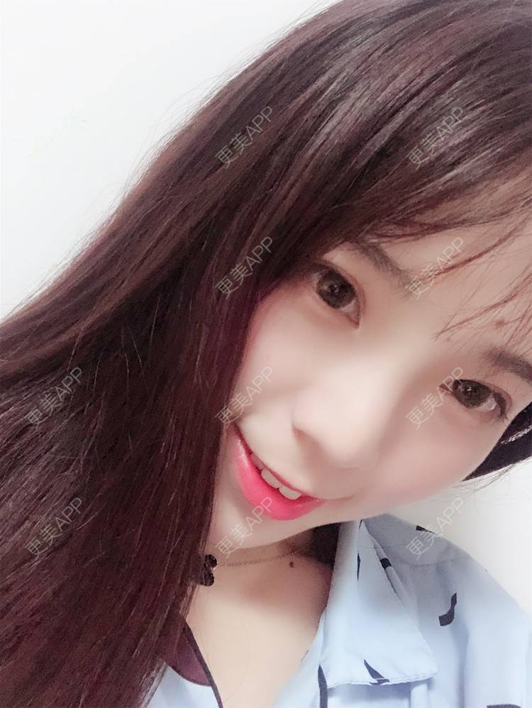 更美 - 叫我乖宝宝的鼻部多项经验 | 视频日记 | 鼻部多项 | 耳软骨隆鼻 | 硅胶隆鼻 | 南京 | 鼻部多项 | 南京