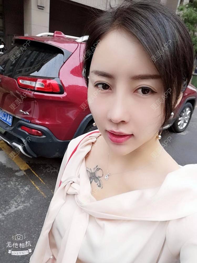 更美 - 更美用户X57YYq4efJ的鼻部多项经验 | 鼻形矫正 | 鹰钩鼻矫正 | 鼻部多项 | 南京