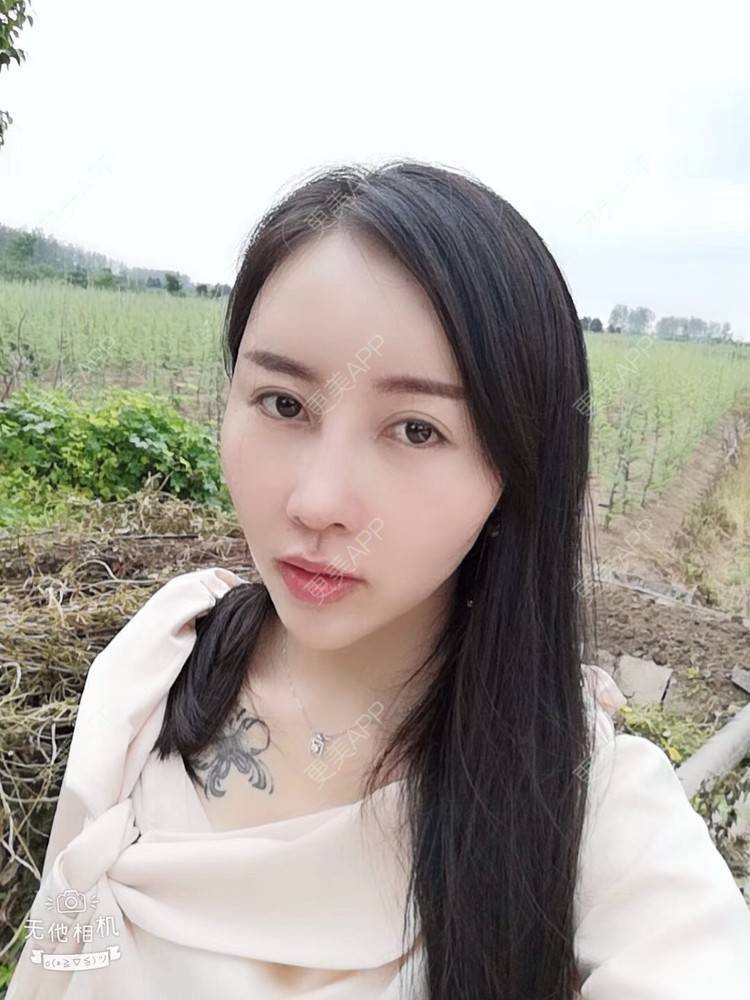 更美 - 更美用户X57YYq4efJ的鼻部多项经验 | 鼻形矫正 | 鹰钩鼻矫正 | 鼻部多项 | 南京