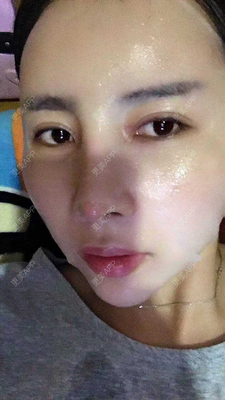 更美 - 更美用户X57YYq4efJ的鼻部多项经验 | 鼻形矫正 | 鹰钩鼻矫正 | 鼻部多项 | 南京