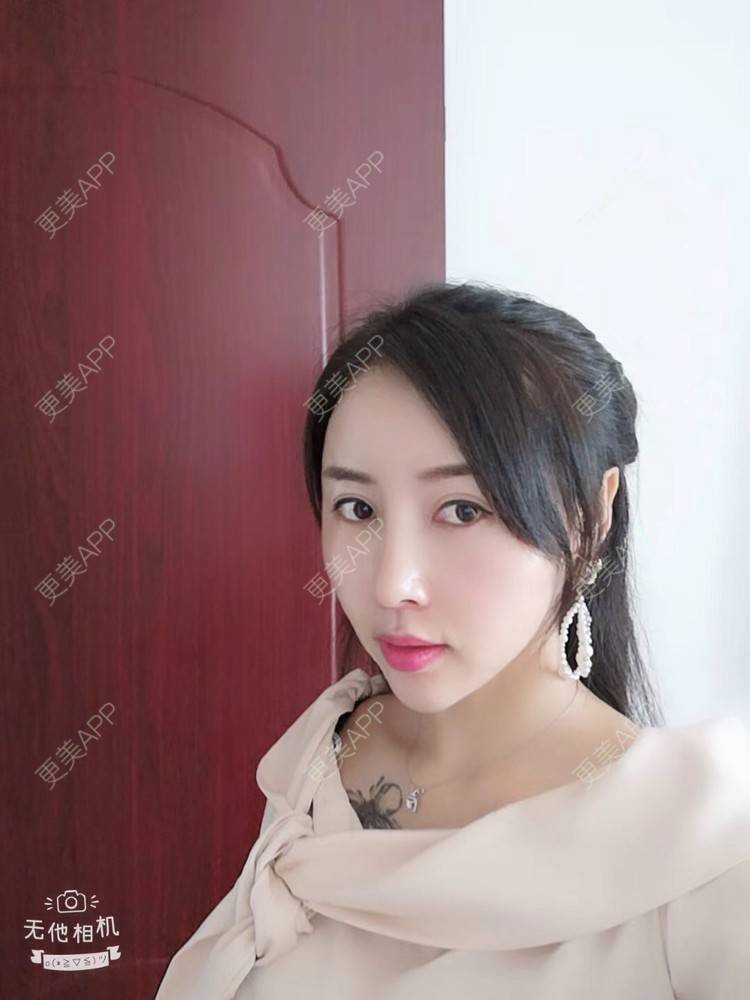 更美 - 更美用户X57YYq4efJ的鼻部多项经验 | 鼻形矫正 | 鹰钩鼻矫正 | 鼻部多项 | 南京