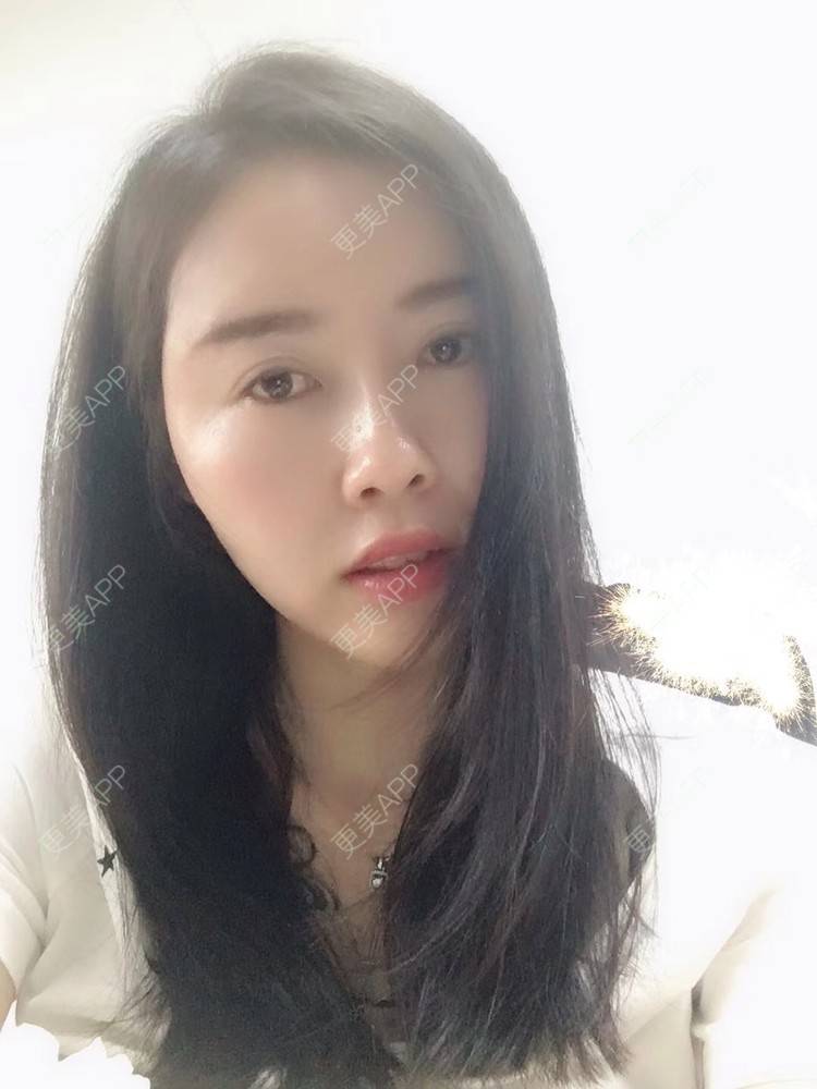 更美 - 更美用户X57YYq4efJ的鼻部多项经验 | 鼻形矫正 | 鹰钩鼻矫正 | 鼻部多项 | 南京